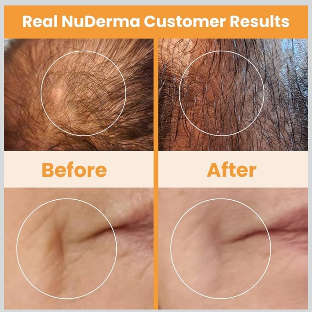 NuDerma Skin Therapy Wand – Anti-Aging/Wrinkle, Skin Tightening, Clarifying - Picture 7 of 11